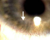 Corneal neovascularization