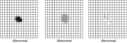 Amsler Grid abnormal results